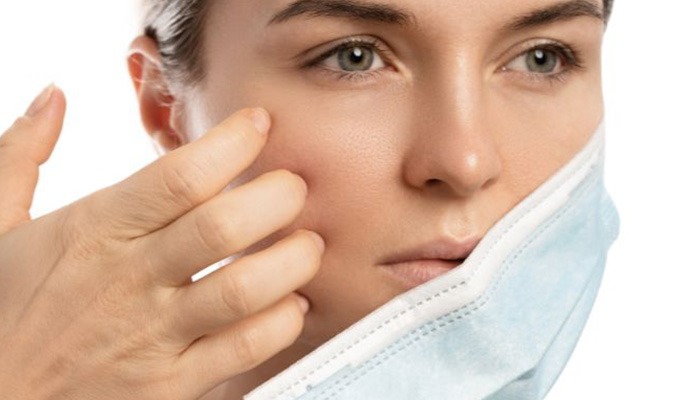 10 Expert Backed Acne Prevention Tips for Clear and Radiant Skin