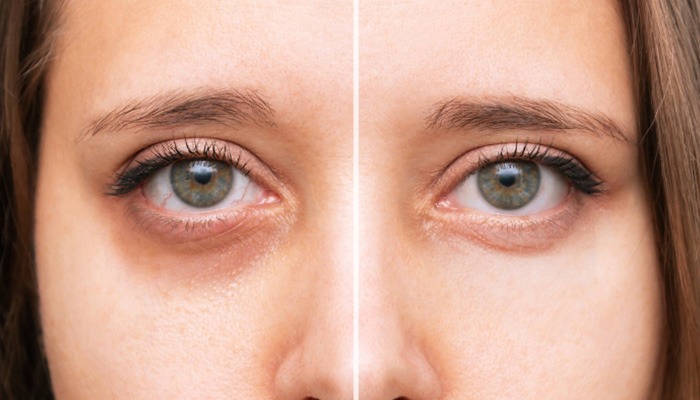 Natural remedies for dark circles